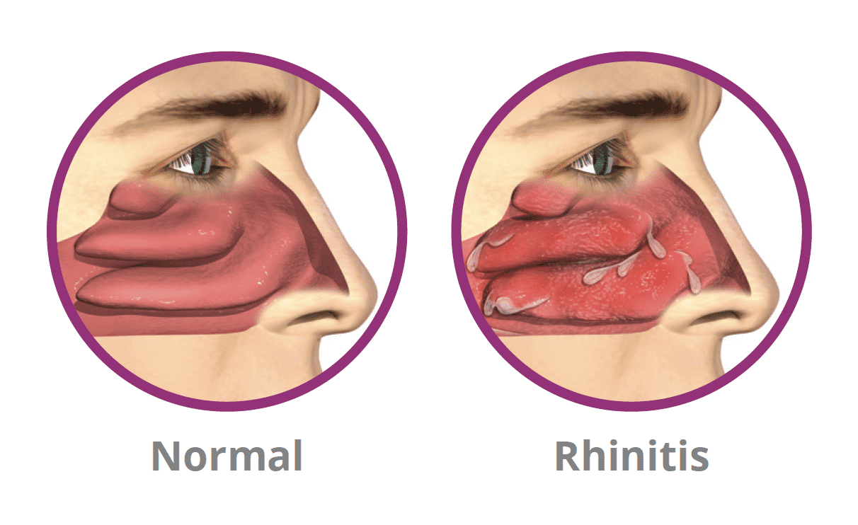 Chronic Rhinitis